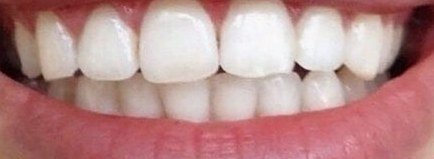 Dents après 5 jours de kit OnlySmile, cliente 1