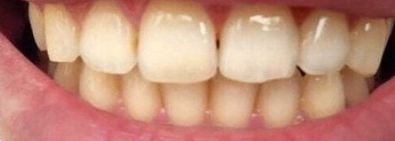 Dents avant le blanchiment OnlySmile, cliente 1