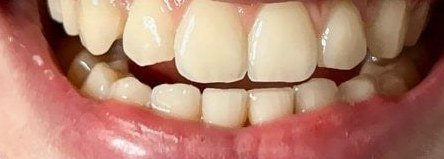 Dents avant le blanchiment OnlySmile, cliente 3